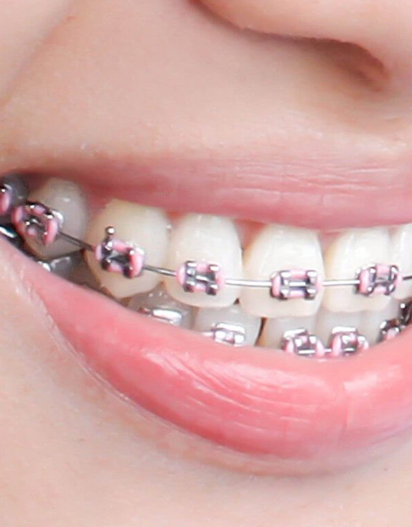 braccialetto per denti