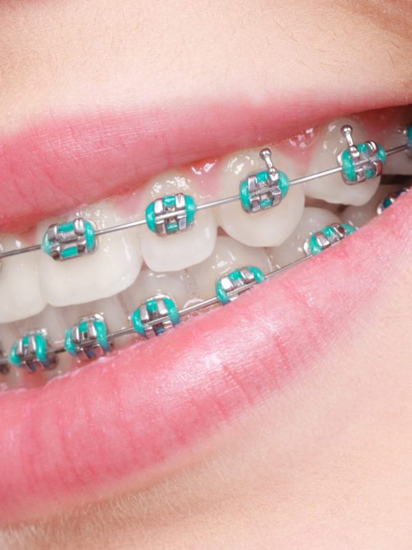 braccialetto per denti 2